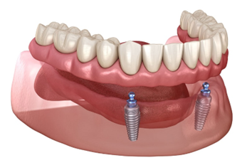Implant-supported overdenture on two implants