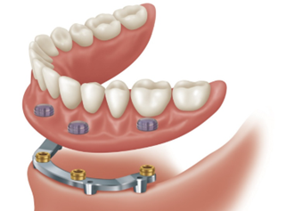 Overdenture attachment system on implant bar