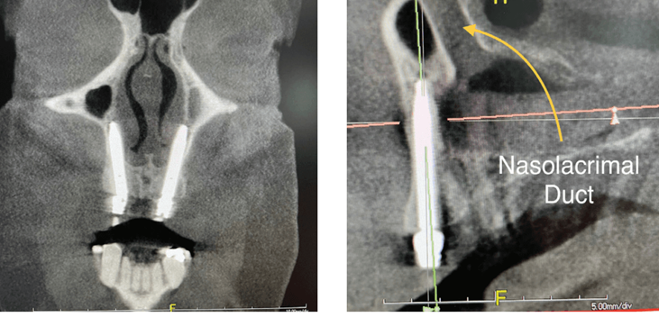 CBCT view of transnasal and transsinus implant positioning