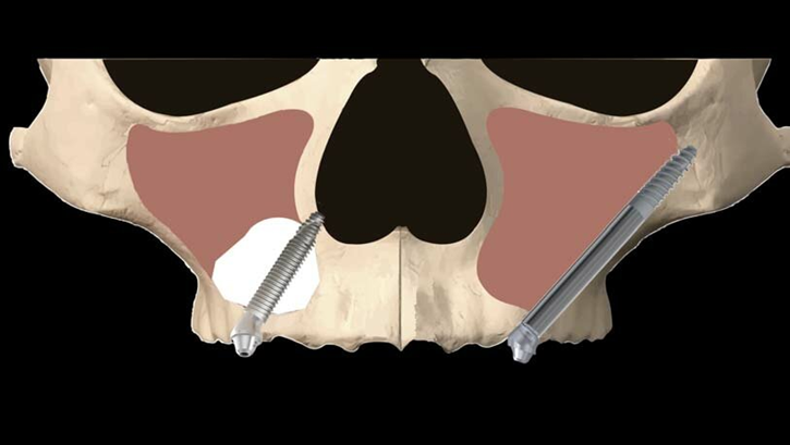 Transsinus and transnasal implant angulation illustration
