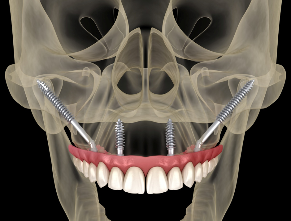 Zygomatic implant full-arch prosthesis illustration