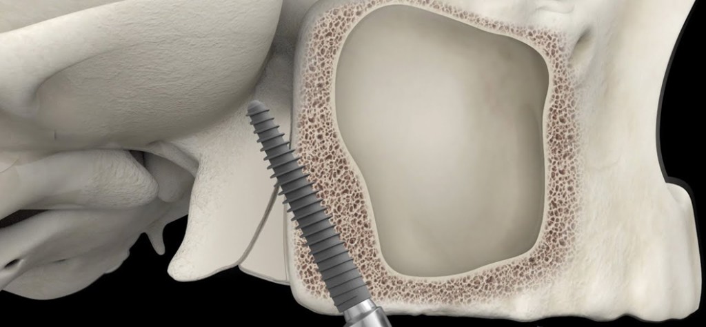 Zygomatic implant anchorage into zygomatic bone illustration
