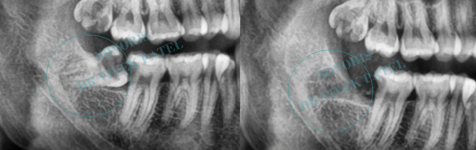 Dental Extraction - Oral & Maxillofacial Surgery at Novoris