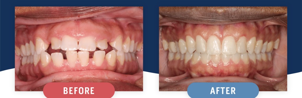 Braces Treatment Before and After - Novoris Orthodontics
