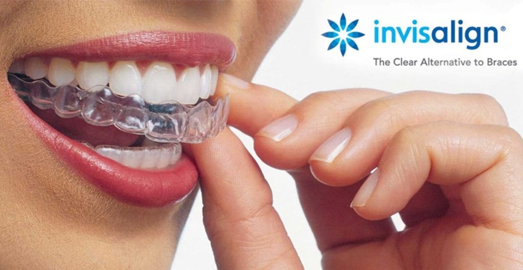 Invisalign - the clear alternative to braces