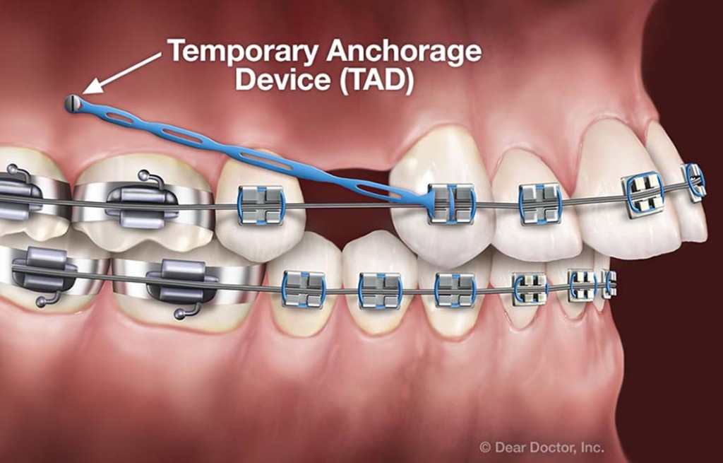 Temporary anchorage device (TAD) for orthodontic treatment