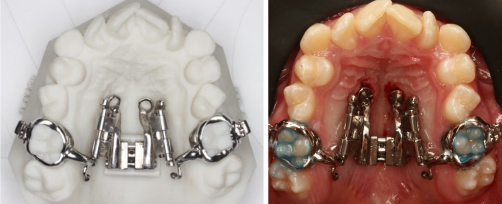 Palatal expander and rapid maxillary expansion appliance
