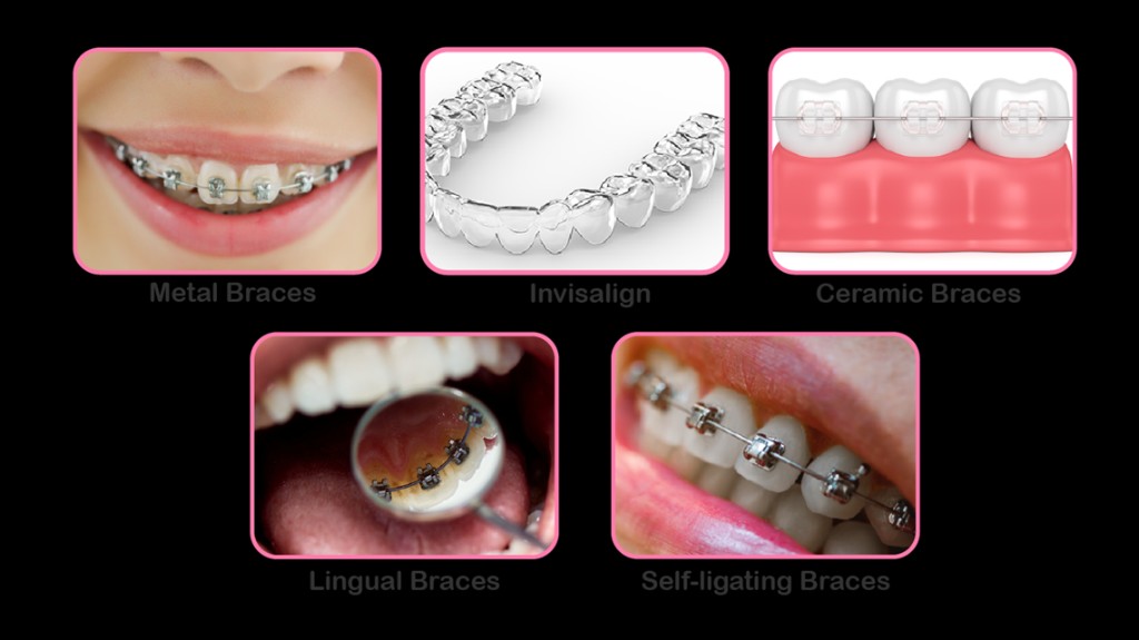 Orthodontic Options - Metal Braces, Invisalign and Ceramic Braces
