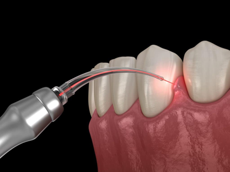 Diode laser application for periodontal soft tissue treatment