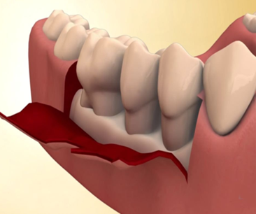 Flap surgery gum reflection illustration