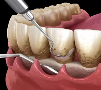 Flap surgery deep cleaning illustration