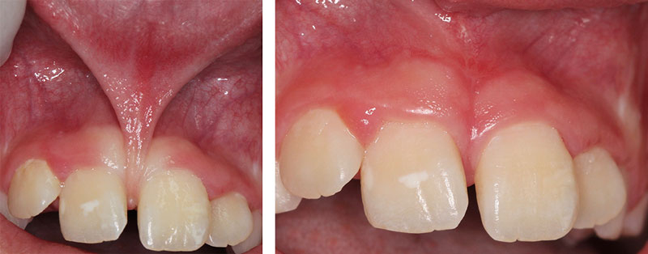 Frenectomy before and after gap closure at the front teeth