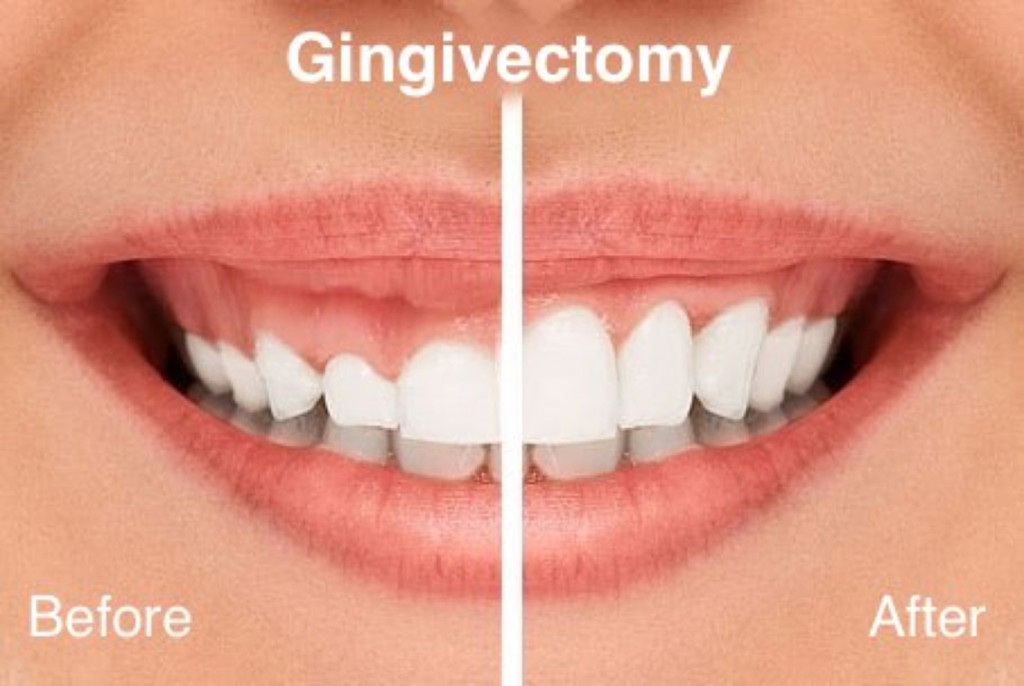 Gingivectomy before and after gummy smile correction