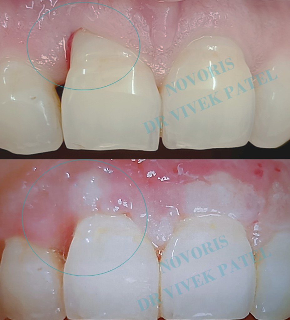 Guided tissue regeneration clinical case before and after