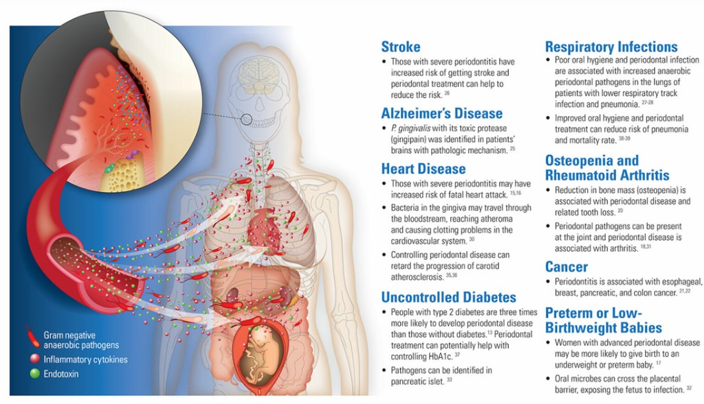 Periodontal medicine and systemic health illustration 2