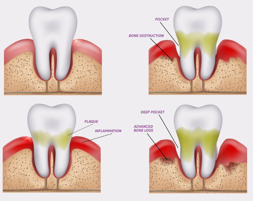 Stages of periodontal disease and bone loss illustration