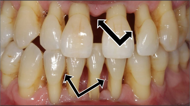 Clinical example of pyorrhoea and gum recession
