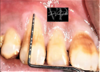 Gum recession evaluation and root coverage planning