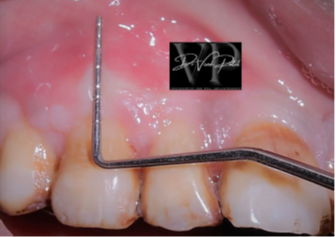 Root coverage surgical site preparation