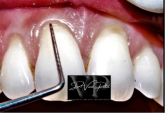 Root coverage procedure clinical image