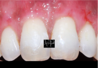 Root coverage final outcome