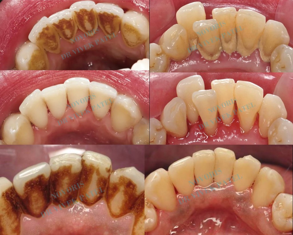 Ultrasonic cleaning before and after clinical case