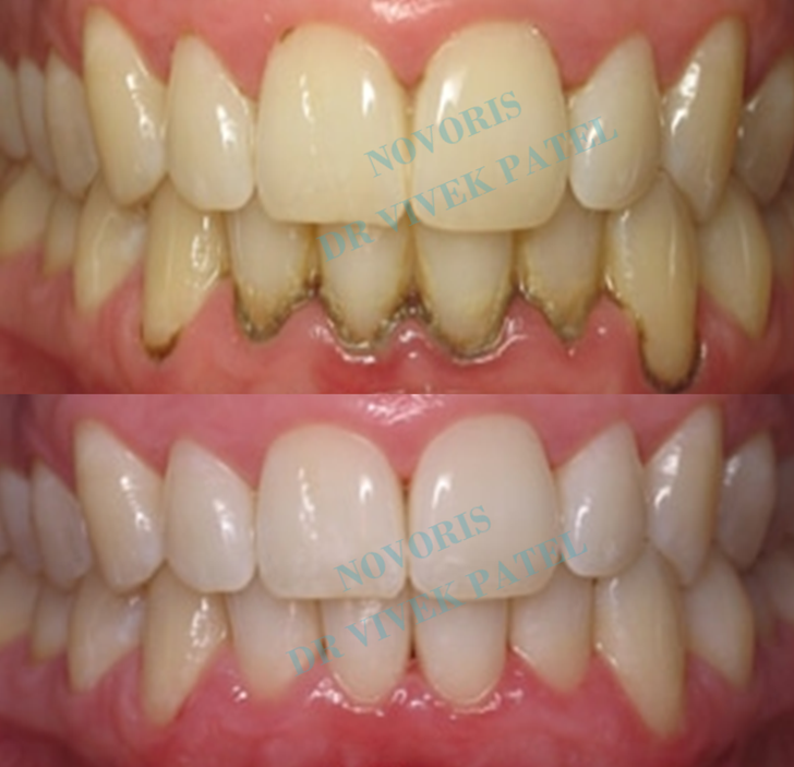 Ultrasonic cleaning before and after result