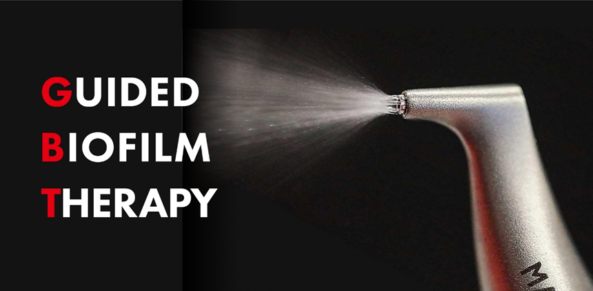 Guided biofilm therapy illustration