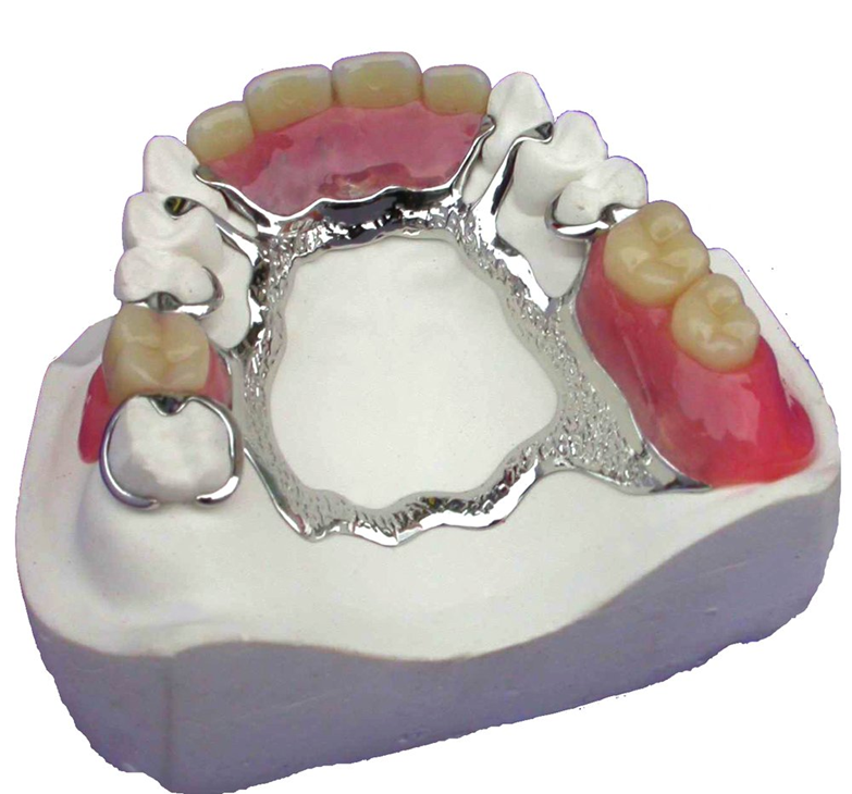 Cast partial denture