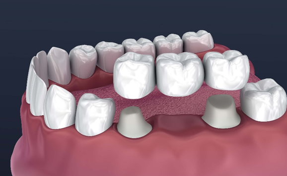 Crowns and bridges treatment illustration - Novoris Ahmedabad