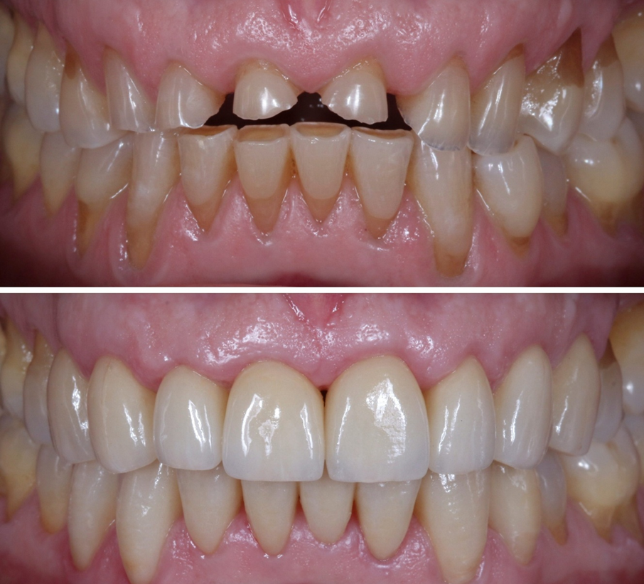 Full mouth rehabilitation before and after - Novoris Ahmedabad