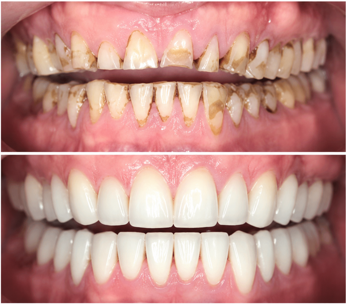 Smile rehabilitation before and after - Novoris Ahmedabad