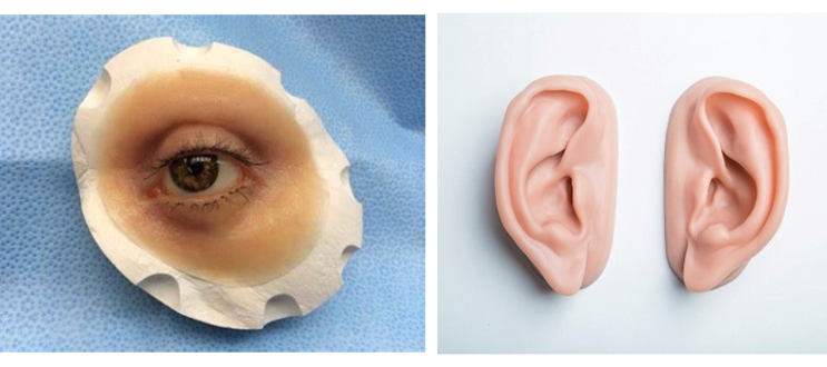 Maxillofacial prosthesis example - Novoris Ahmedabad