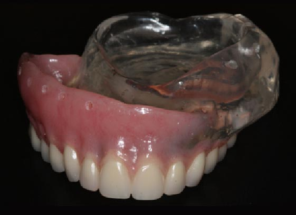 Maxillofacial rehabilitation prosthesis example - Novoris Ahmedabad