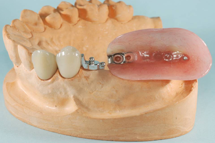 Precision attachment overdenture