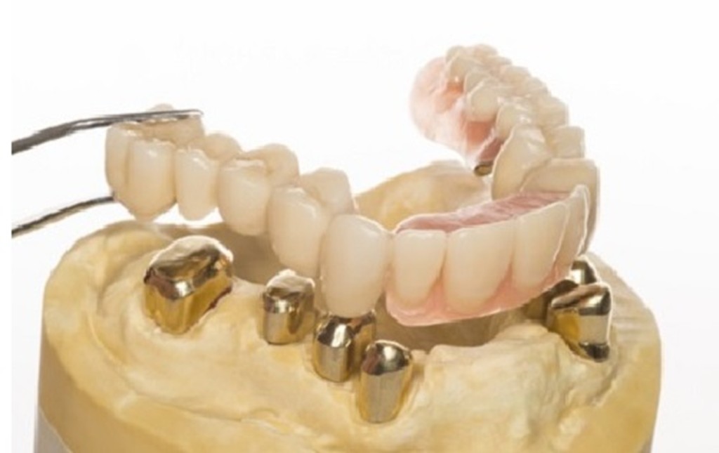 Tooth-supported overdenture image
