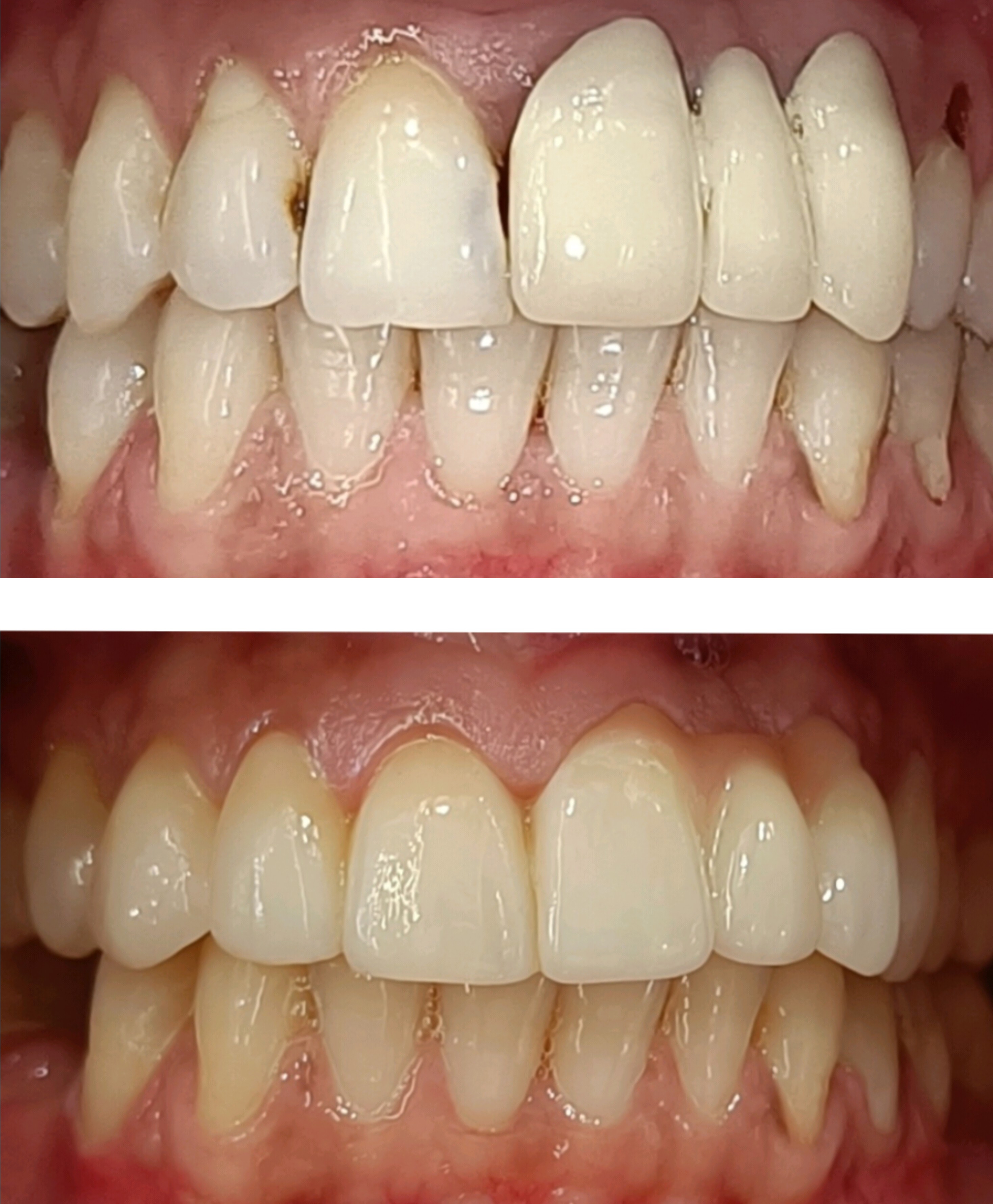 Smile makeover before and after full aesthetic transformation