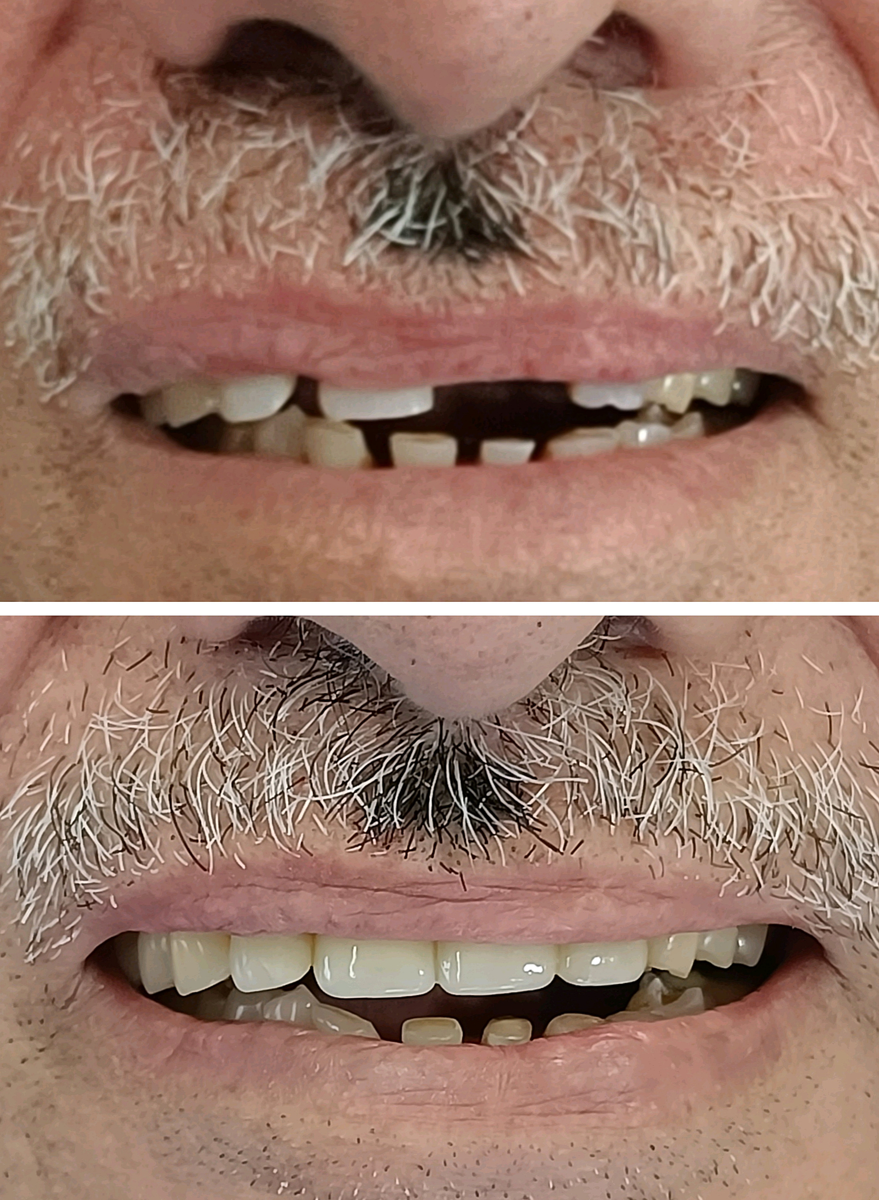Smile makeover before and after full aesthetic transformation