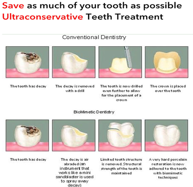 Biomimetic dentistry compared with conventional restorative treatment
