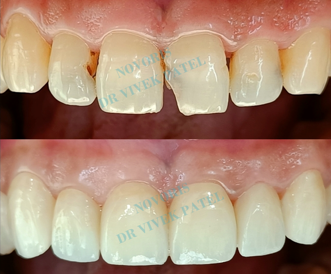 Dental veneers before and after smile makeover