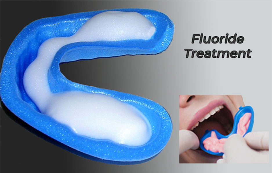 Fluoride treatment tray used in preventive dental care