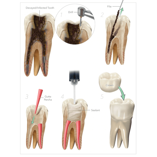 Root canal treatment steps and crown restoration illustration