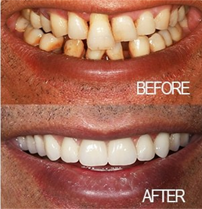 Smile makeover before and after full aesthetic transformation