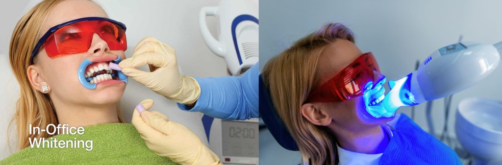 In-office professional teeth whitening treatment