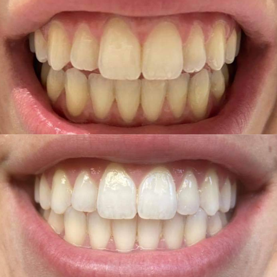 Teeth whitening before and after smile result