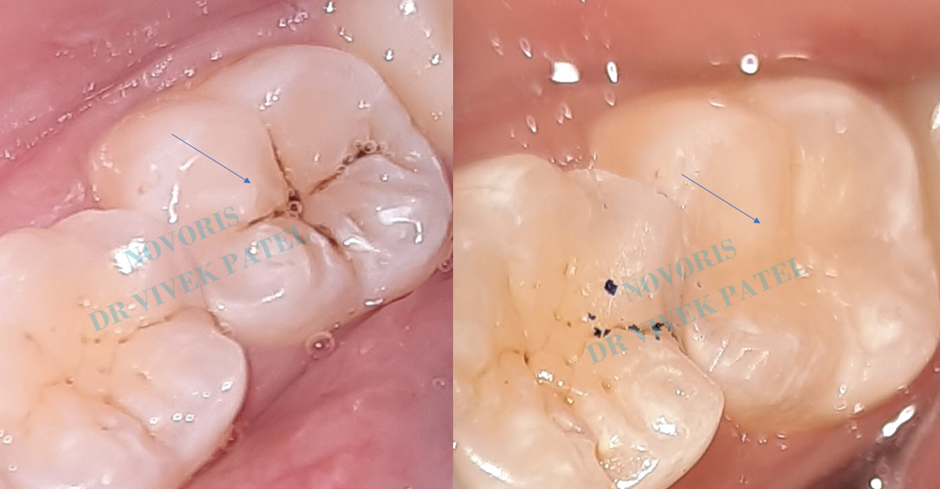 Tooth-colored filling before and after restoration