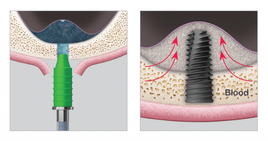 Advanced dental implant equipments - image 4