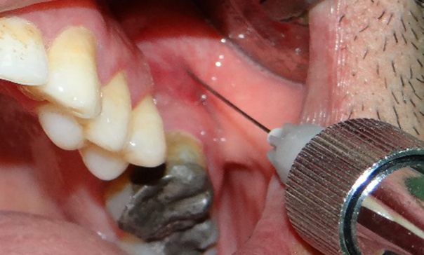Fine injection technology