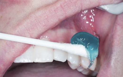 LA gel application