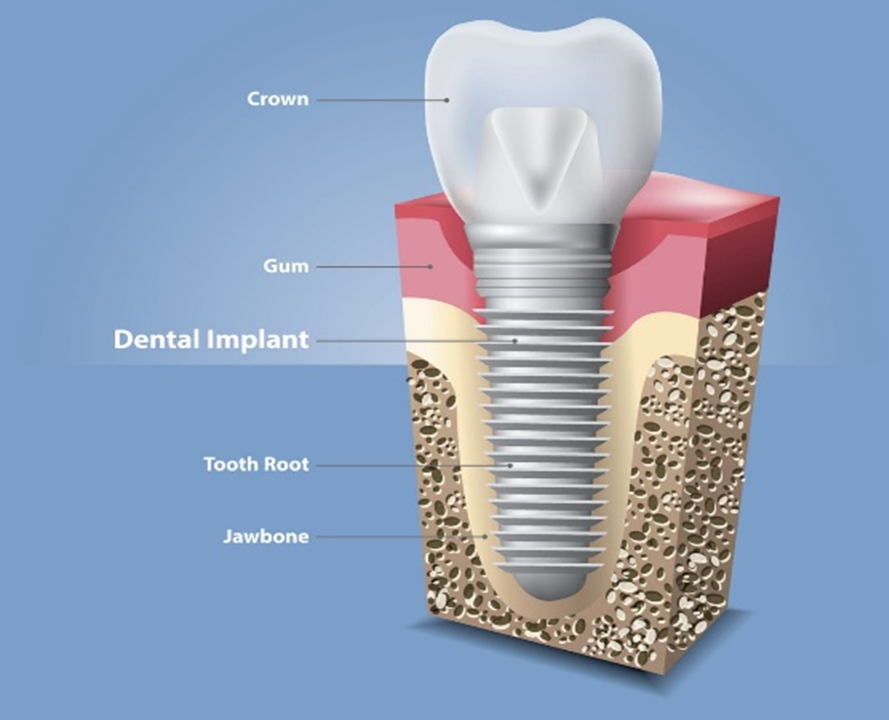 Dental implants- step by step procedure